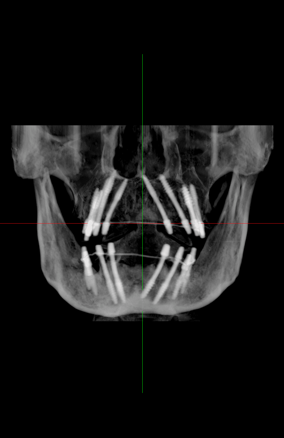Cortico Core