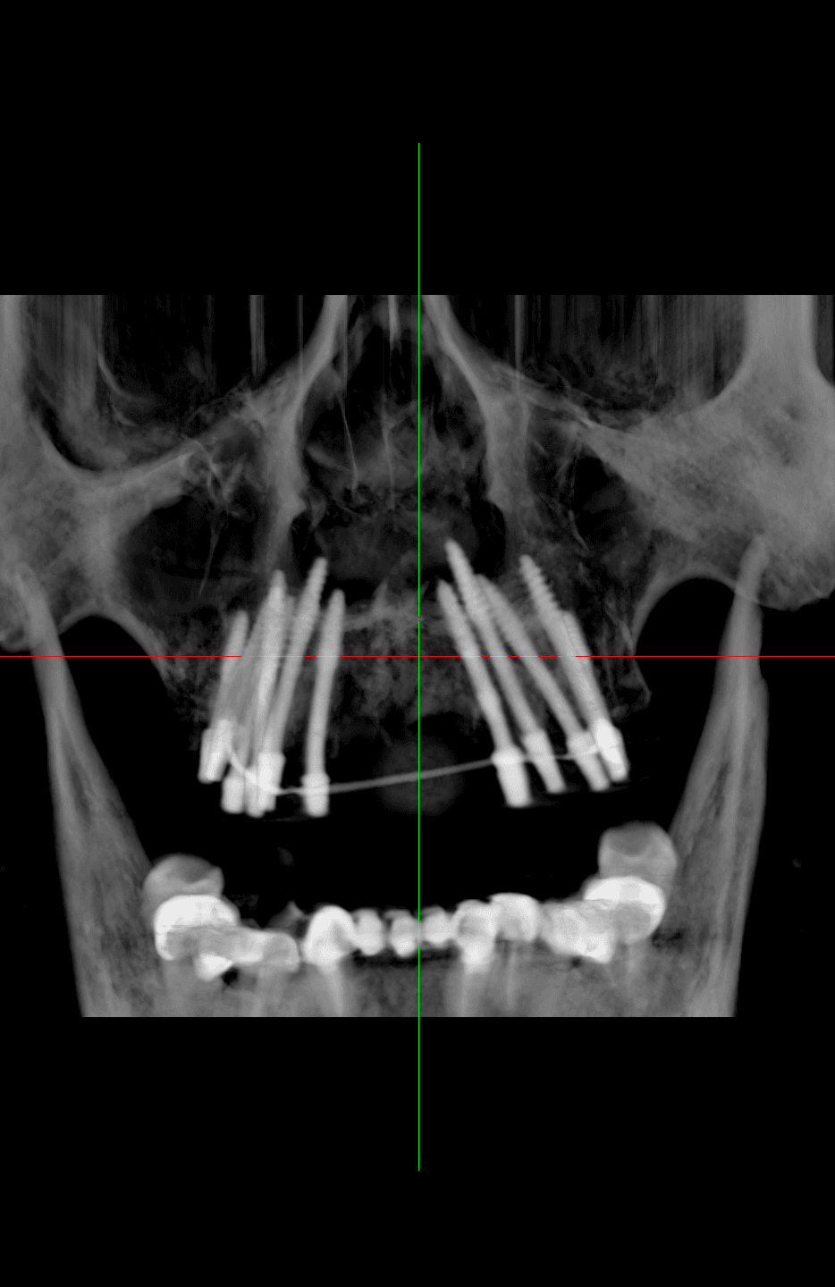 Cortico Core