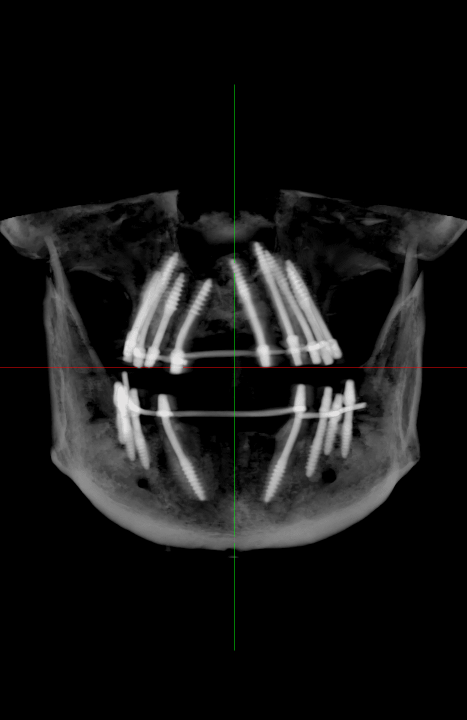 Cortico Core
