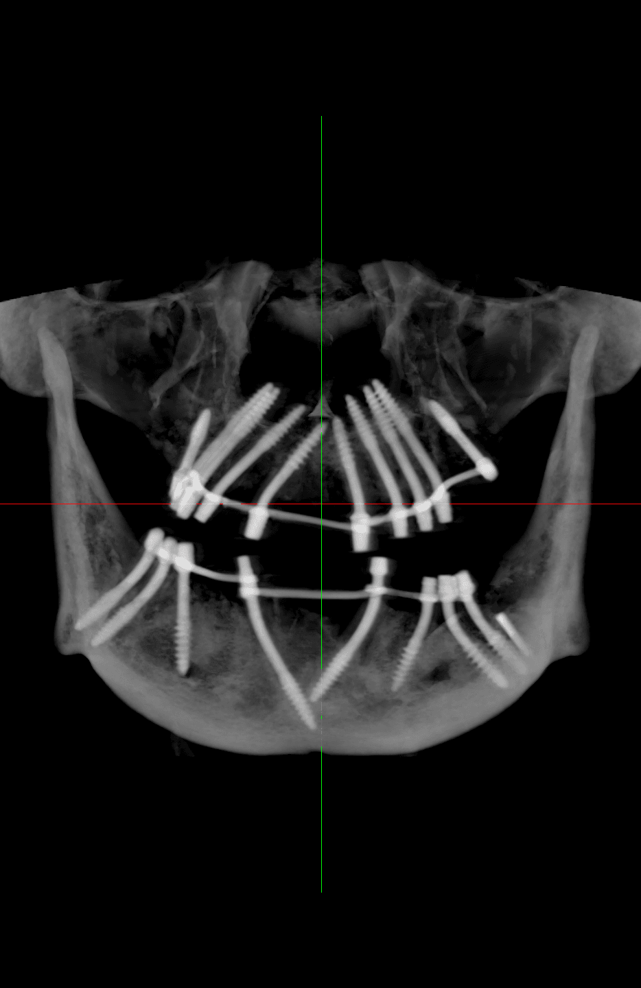 Cortico Core
