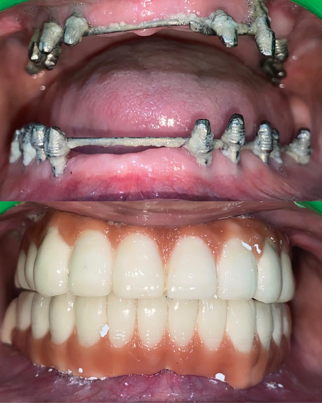 Master Prosthesis